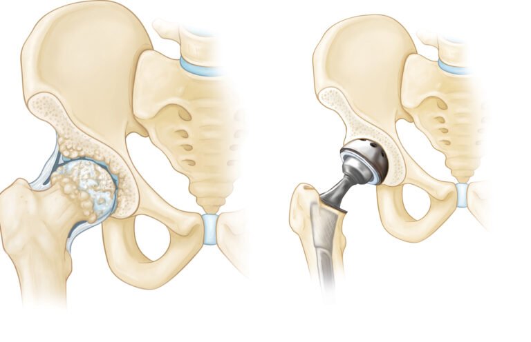 Arthroscopy Explained: A Minimally Invasive Solution for Joint Problems!