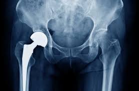Let’s Talk About Total Hip Replacement Surgery!